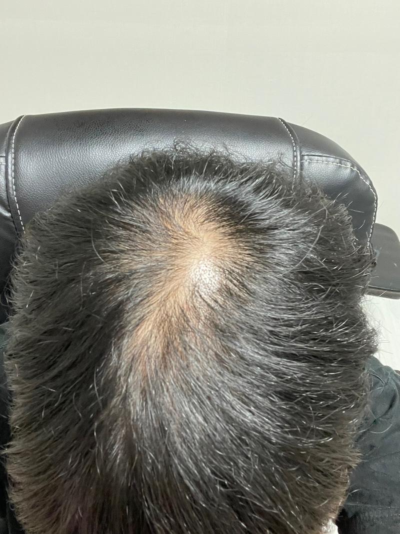 脱毛判定 このまま崩れるわけにはいかない