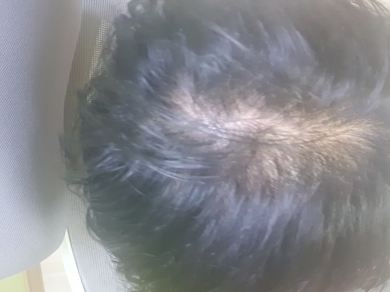 20岁 头破型脱发...