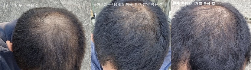 두타 복용 전/후, 처방약 복용 1개월