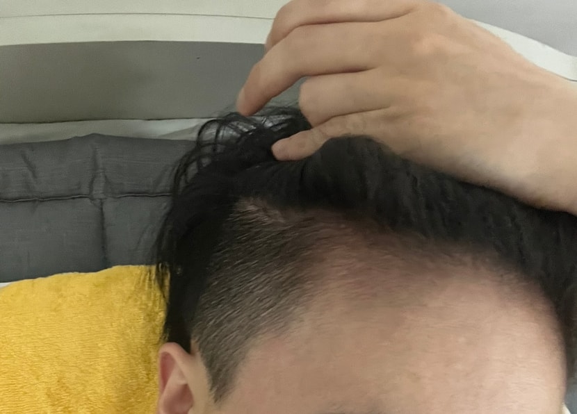 미녹시딜정 복용 3개월차