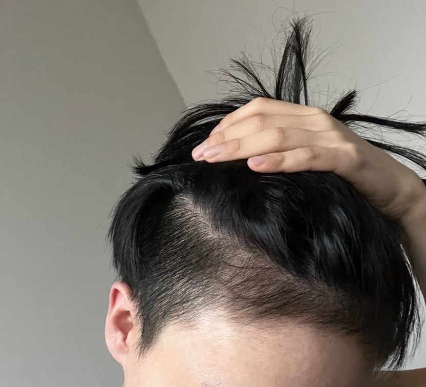 미녹시딜정 복용 12개월차