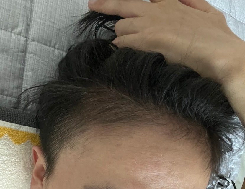 미녹시딜정 복용 6개월차