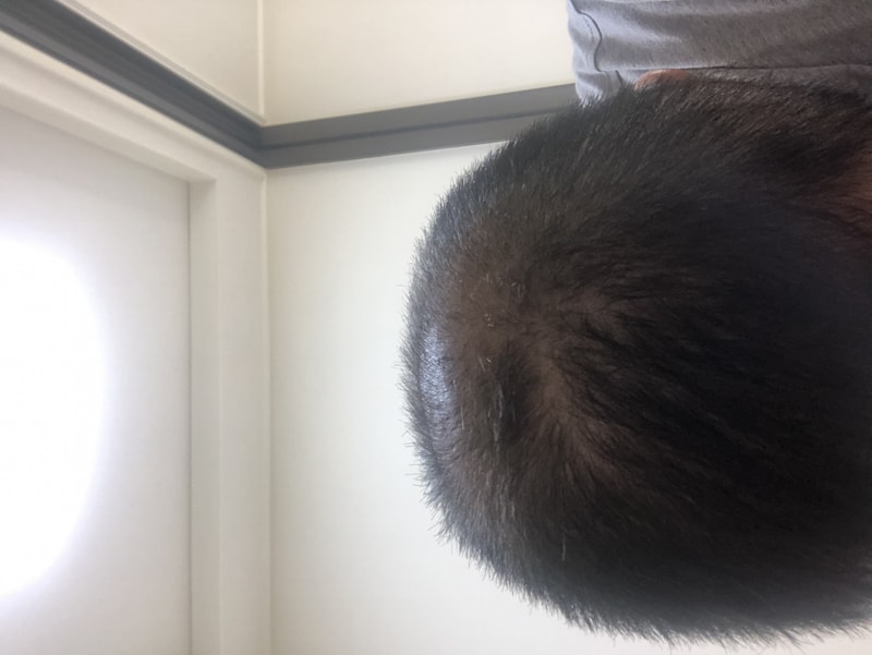 我的头发状态是头破型脱发吗？