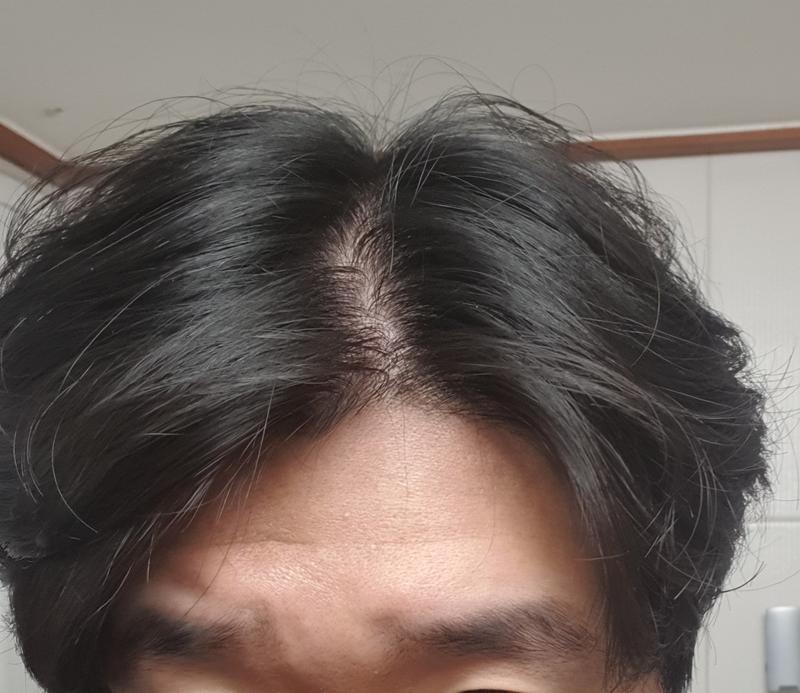 모발 이식을 고려해야 할까요?