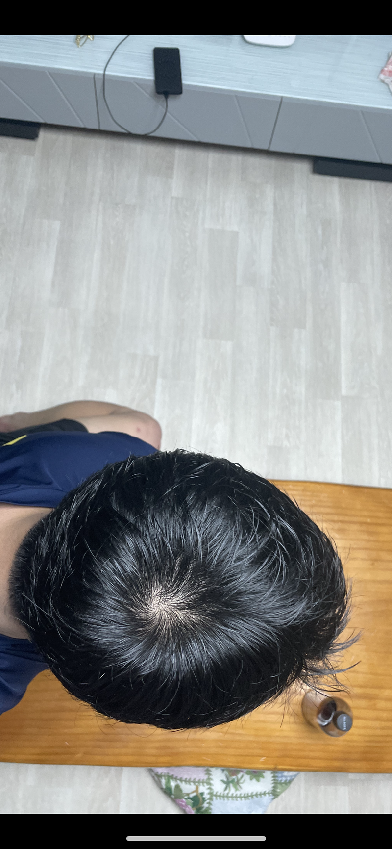 정수리탈모 아보다트+미녹 8개월차