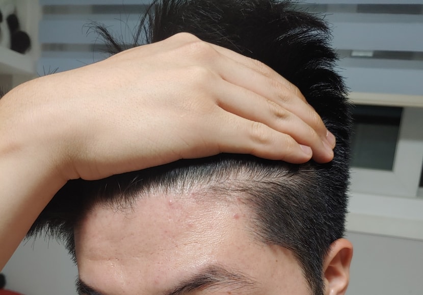 상대적으로 양호한 왼쪽헤어라인
