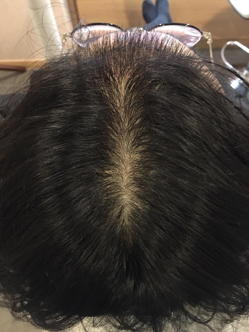 엑소좀, 보톡스 주사 탈모치료