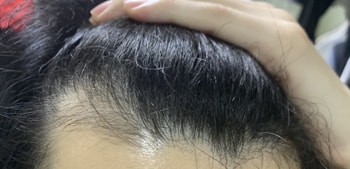 현재 이마 라인입니다. 