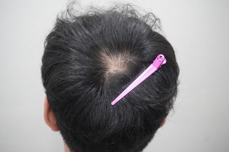 뉴헤어부산의원 주사치료 첫날후기