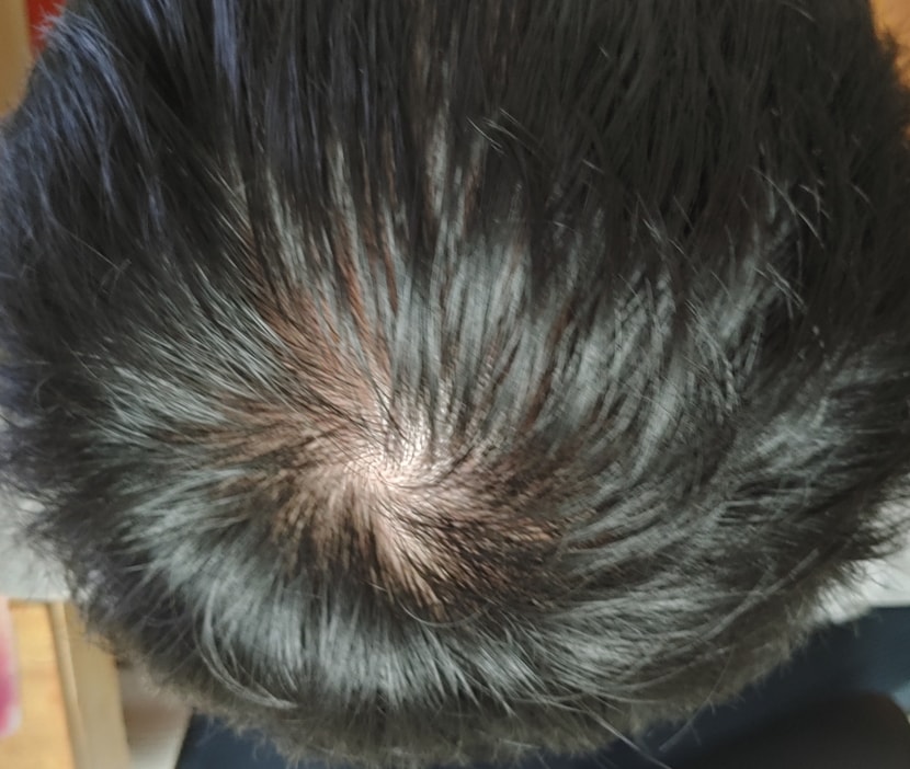 약 바른 뒤 머리