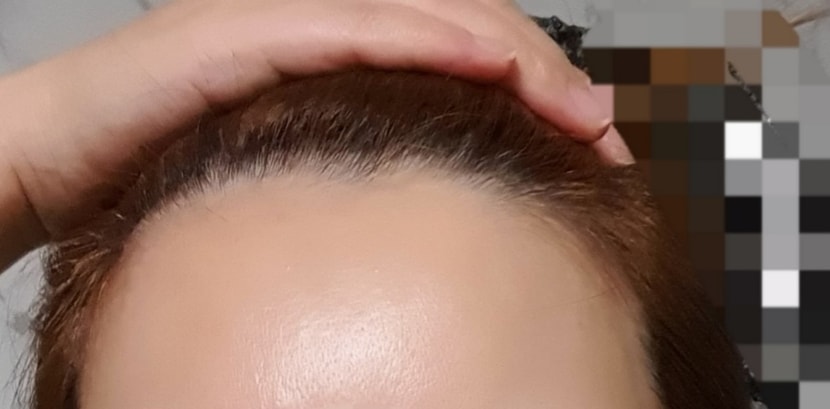 이식전