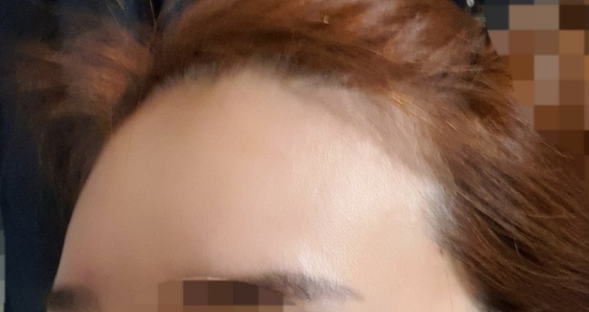 이식전