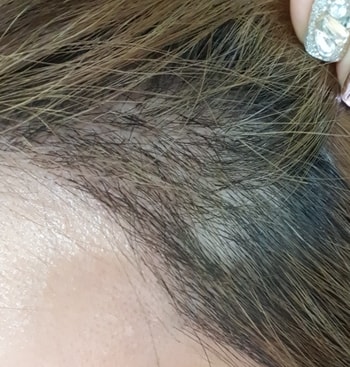 이식20일차 현재 사실...지금부터 암흑기시작이라는데..아직 잘모르고 지내고잇어요