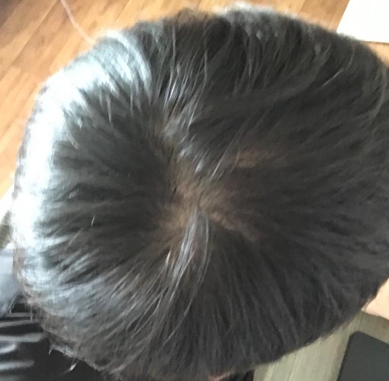 AGA治療薬を飲んでからちょうど1年になりましたね···
