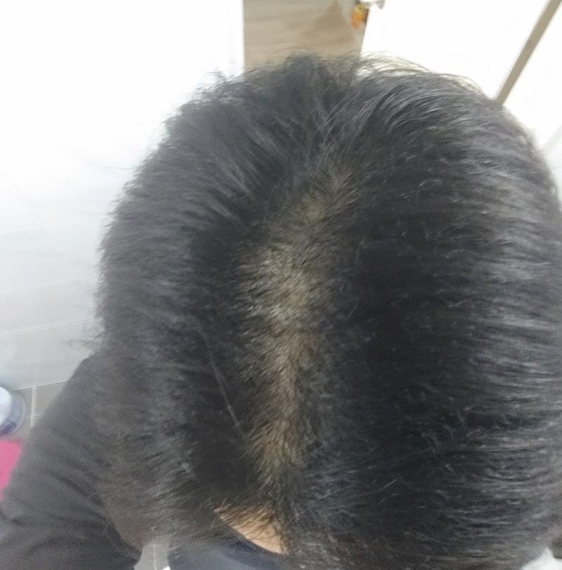 (20대 초반) 살려주세요 진짜 탈모가 오나 너무나도 무섭습니다 ㅜ ㅜ 판단좀 해주세요 형님들