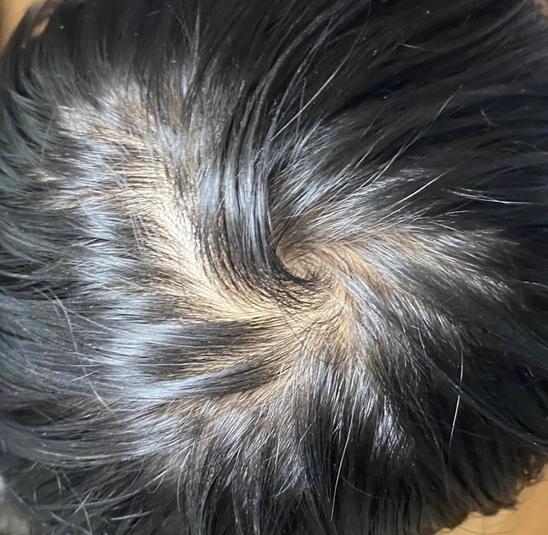 프로페시아 5개월차 입니다