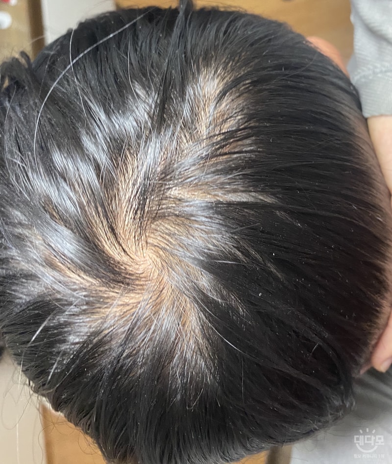 24살 프로페시아 2개월차 입니다