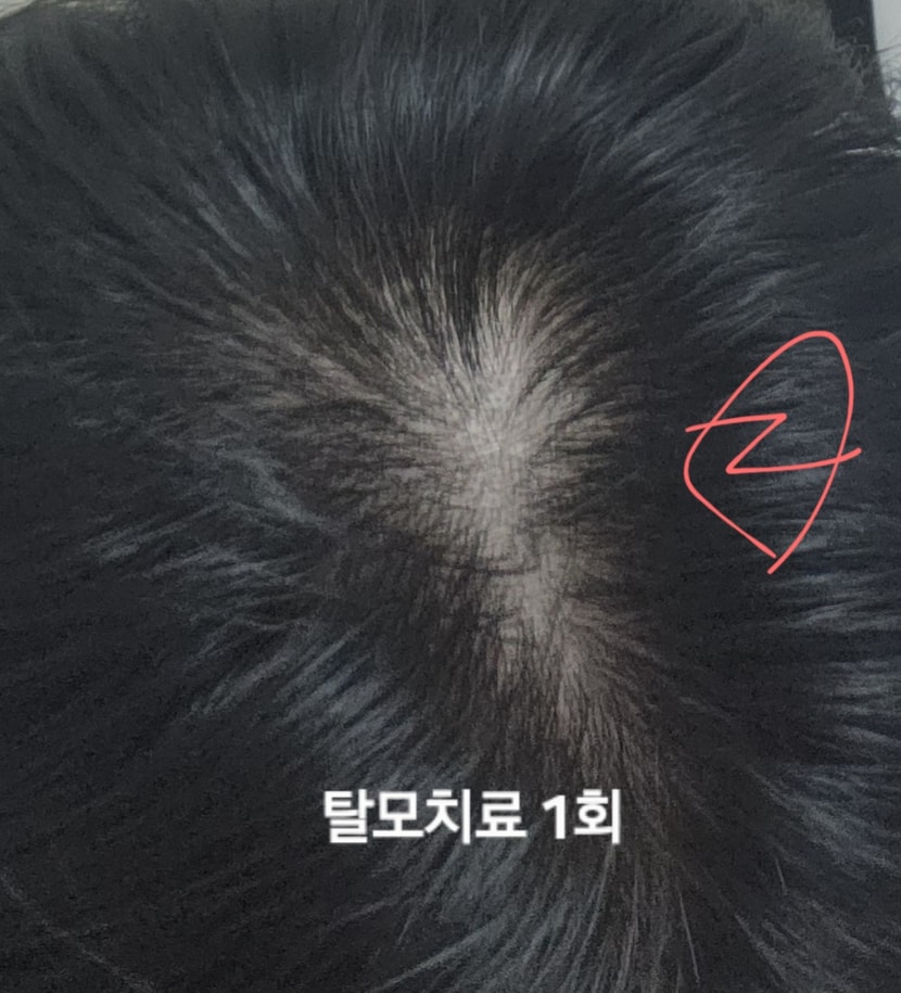  탈모치료 침1회 받은 상태