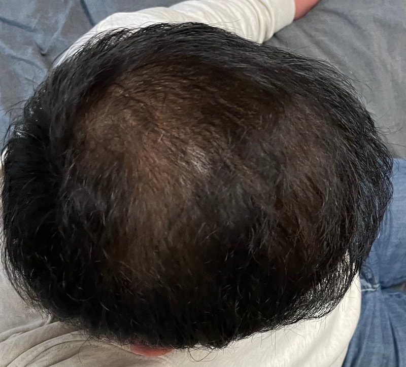 정수리 고민상담ㅠㅠ