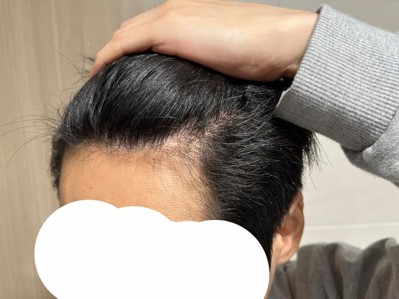 이제 모발이식 할 시기가 된거겠죠?