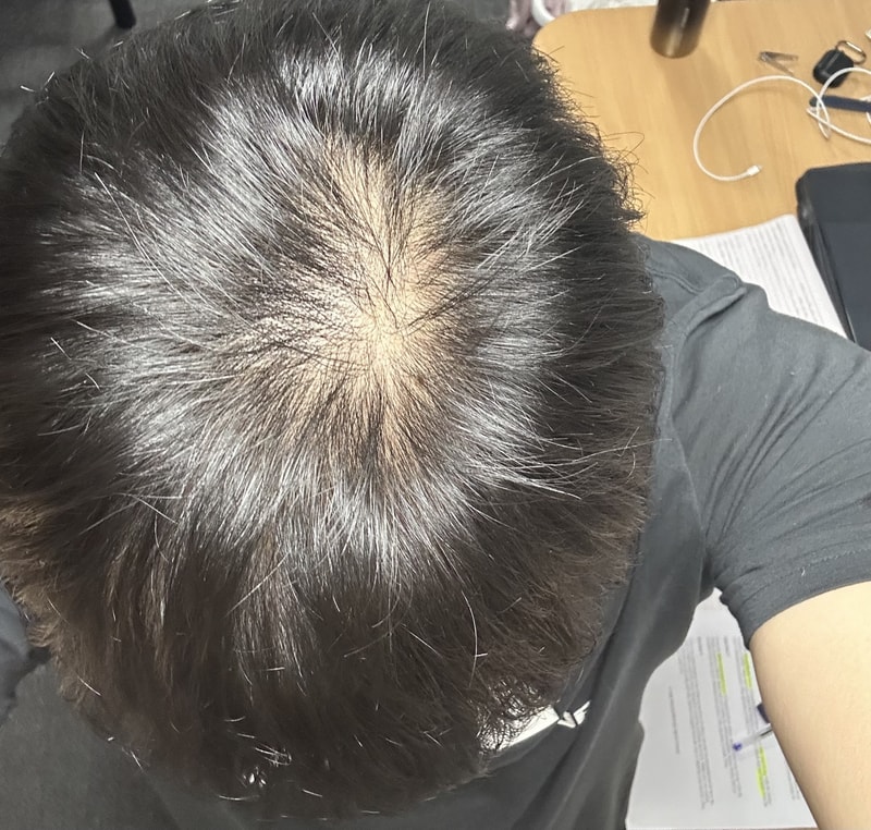 是20岁出头的脱发吗？