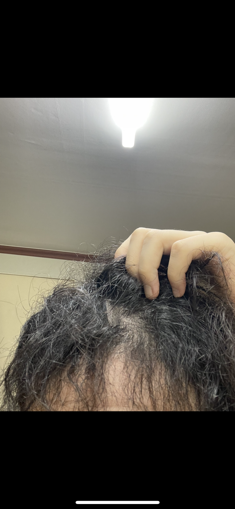 26살  탈모+악성곱슬때문에 사는게 힘들군요