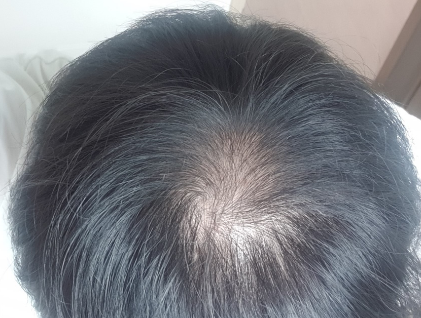 탈모 발견 초기