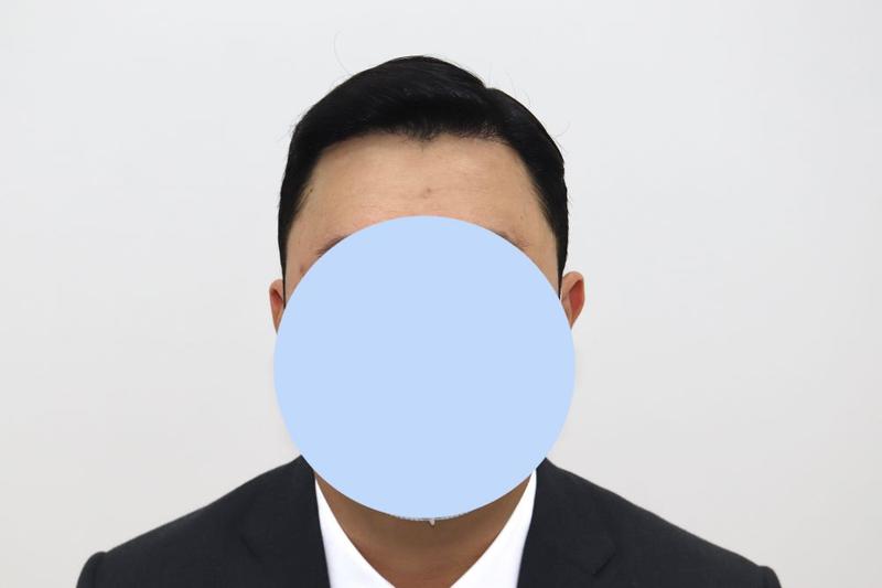 대구 포헤어 모발이식 후 실적도 자신감도 상승세입니다