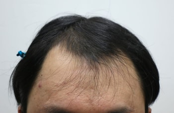 수술 전