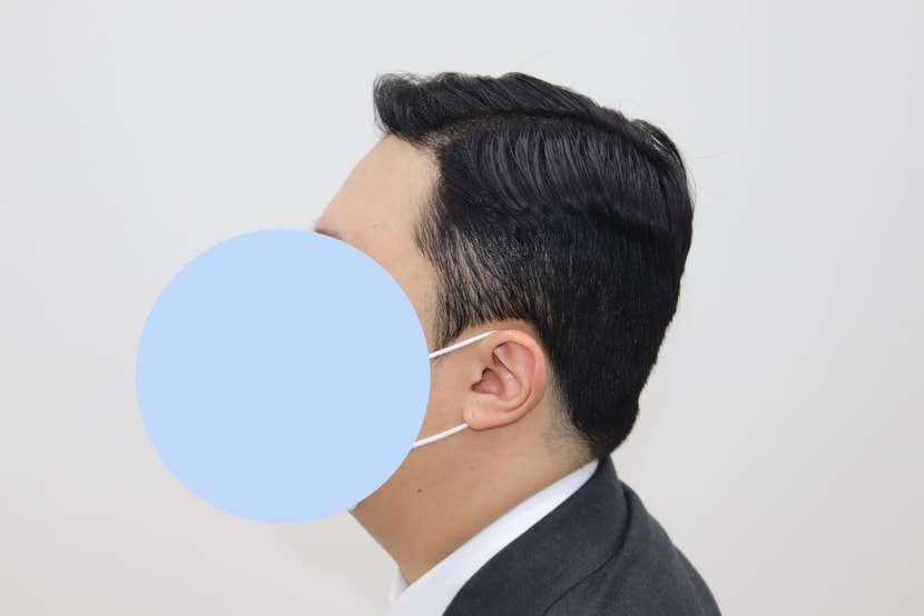 수술 후(7개월)