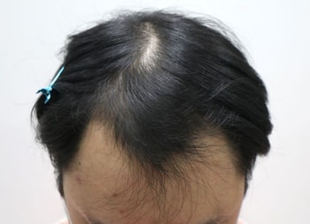 수술 전