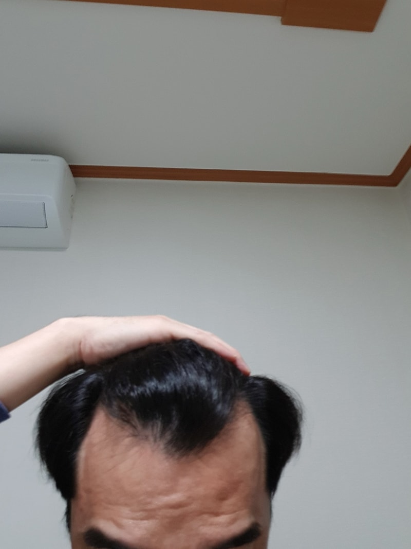 Inquiry about M-shaped hair transplant