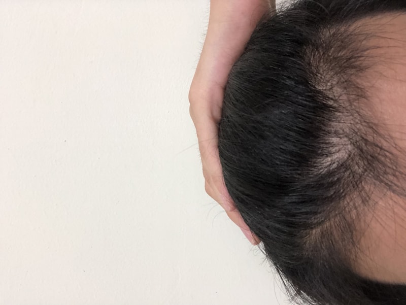 이정도면 탈모몇단계일까요..?