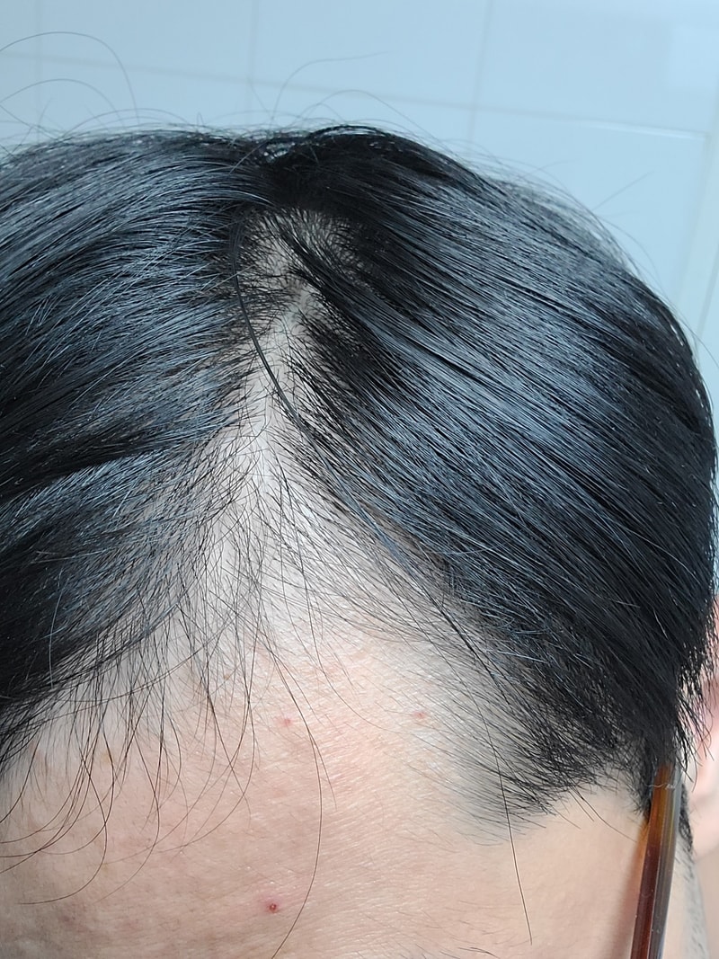 프로페시아 한달차입니다.  다시올림