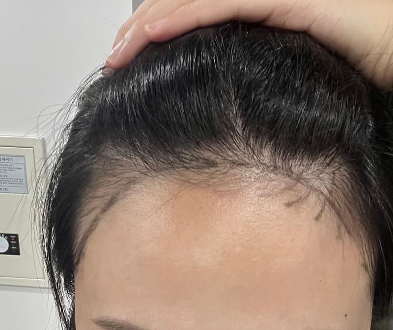 接受Pohair咨询后马上预约了手术~！