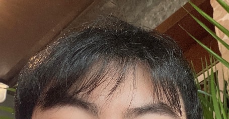 아보다트 8개월차 전후