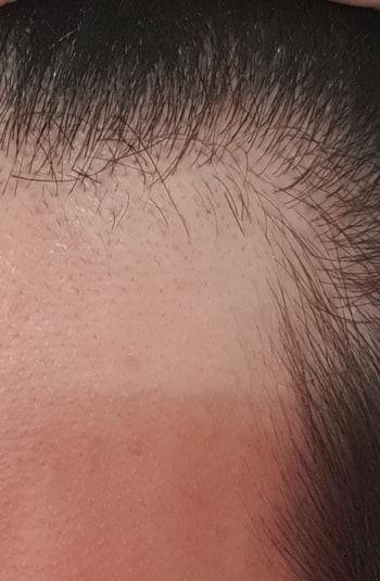 현재:검은잔털은 제가 면도기로 잘못밀어서 생겼어요ㅠ