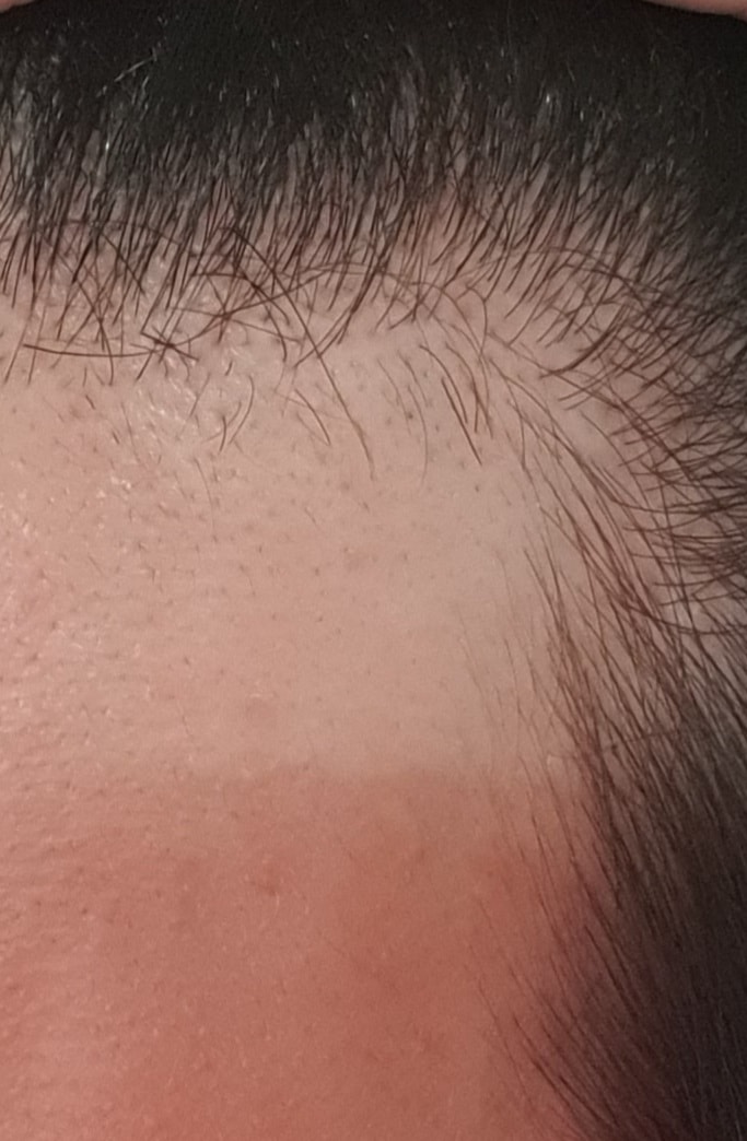 현재:검은잔털은 제가 면도기로 잘못밀어서 생겼어요ㅠ