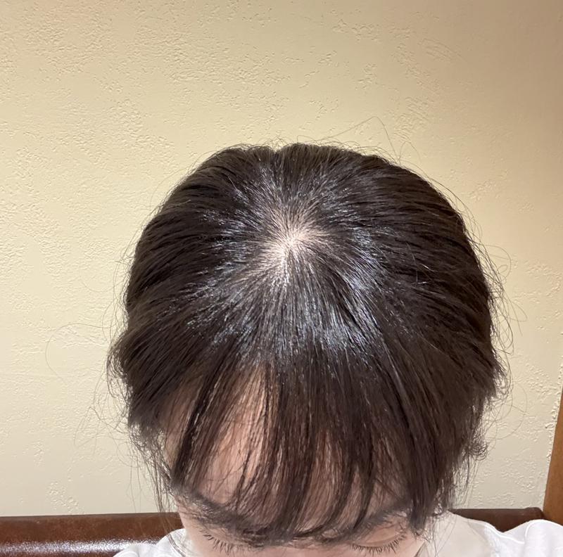 35세 여, 탈모초기일까요…?