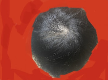 약먹고 2달차 12월 초쯤(지난번에 올렸었는데 아무래도 각도때문에 더 많아보인거같아요)