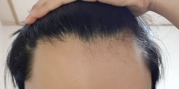 1년전 사진입니다. 이때도 딱히 지루성두피염은 없었습니다.