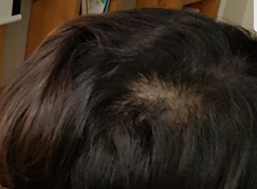  2년전 사진입니다. 이때는 딱히 지루성 두피염도 없었던 상태였습니다.