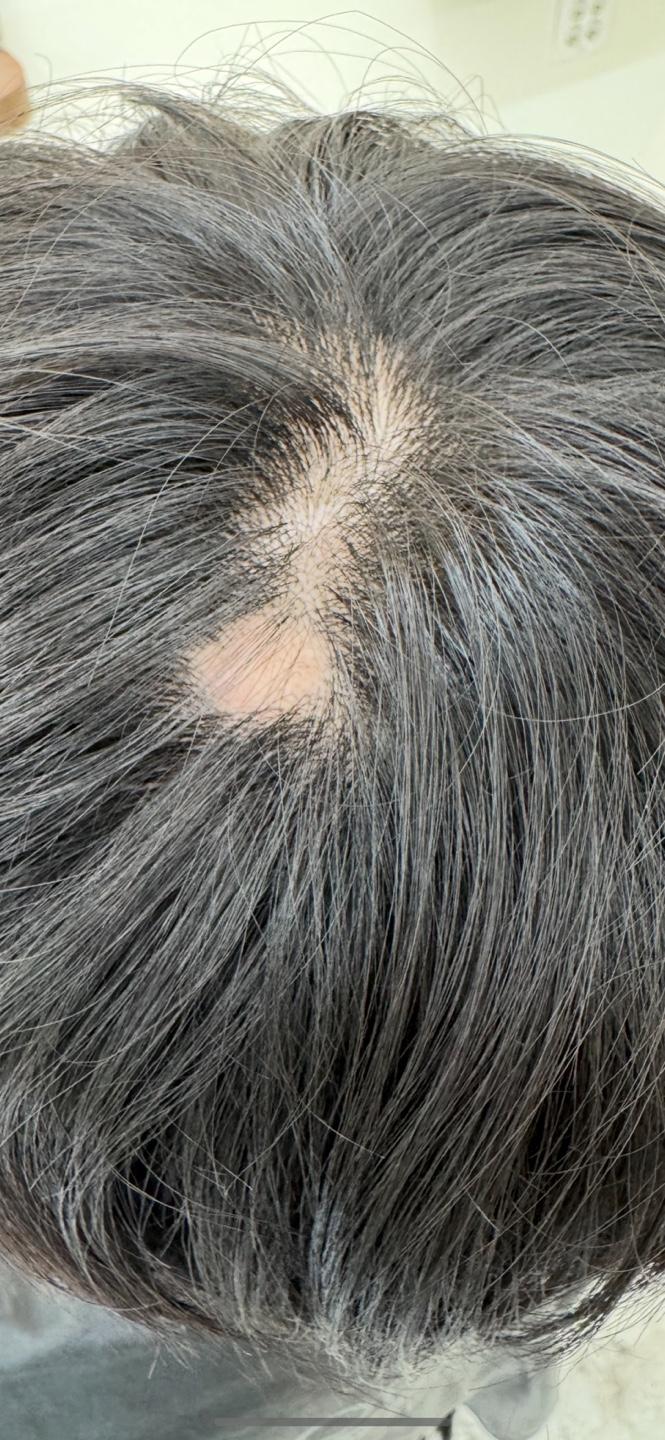This is circular hair loss, right??