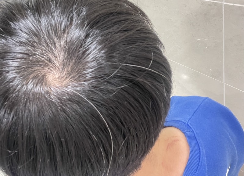 28살 프로페시아 먹는데 나아지는거 같지 않네요 ㅠㅠ