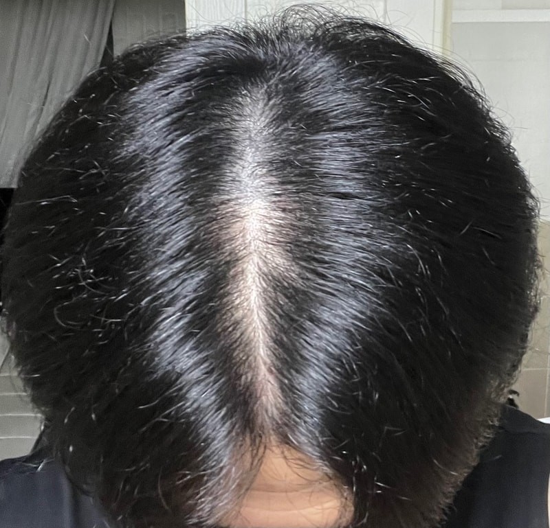 이거 유전형 탈모인가요?