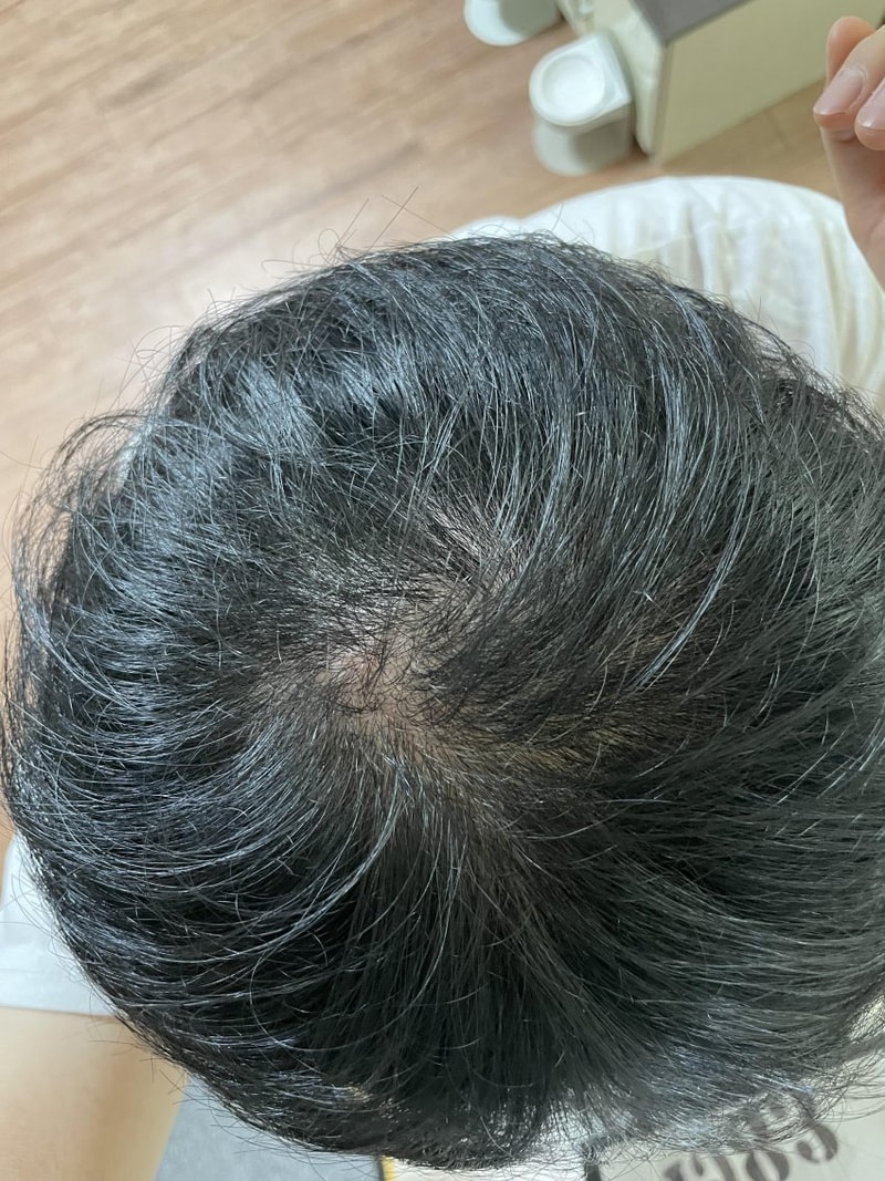 사람 살린답시고 탈모 조언 부탁드립니다.. 제발 너무 힘듭니다.