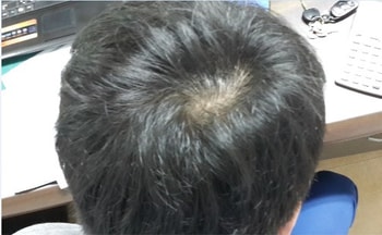 정수리1