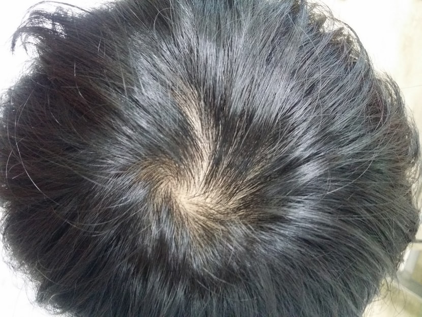 정수리2