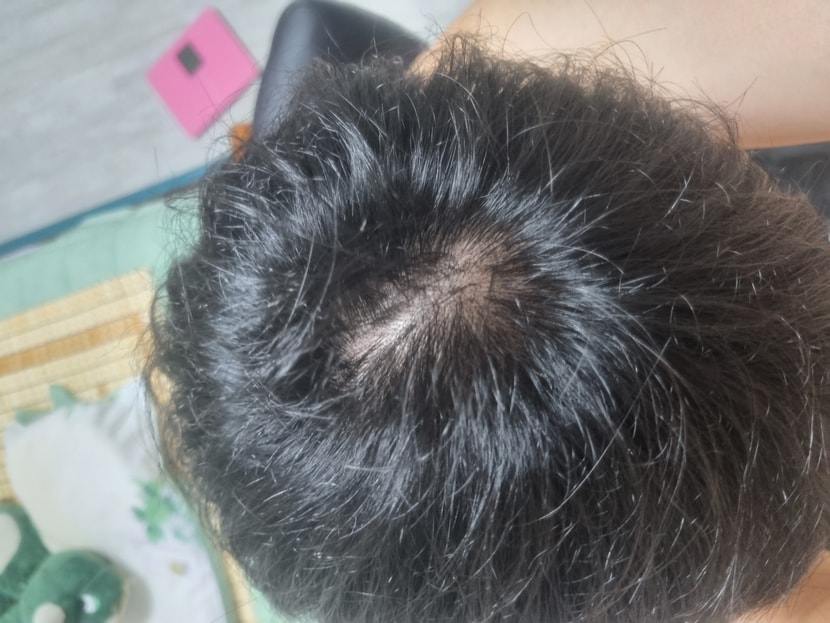 안녕하세요. 34세 남성입니다. 정수리 궁금해서 찍어봤는데 좀 개인적으로 심각해보여서 혹시 탈모가 진행중인거 아닌가 싶어 올리게되었습니다.