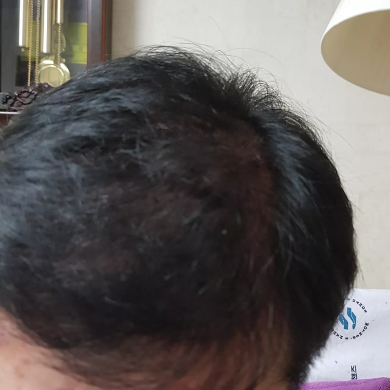 휴지기 탈모로 이렇게 많이 털렸어도 판토가가 효과 있을까요?